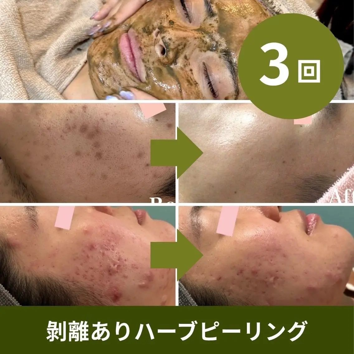 【3回分】回数券🉐ハーブピーリング(剥離あり)🌿2回目以降も1回9,800円！通常13,800円/回の写真