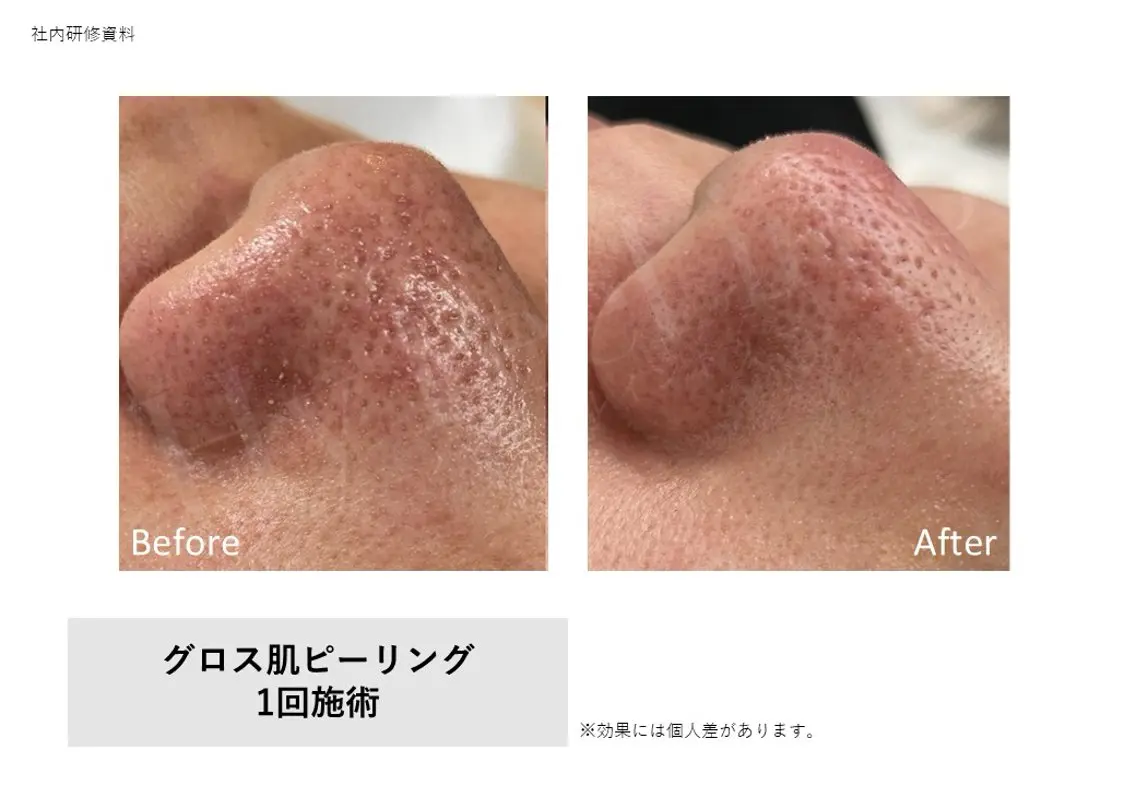 【口コミクーポン🉐】ハイドラピーリング 〈毛穴スッキリ洗浄✨〉の写真