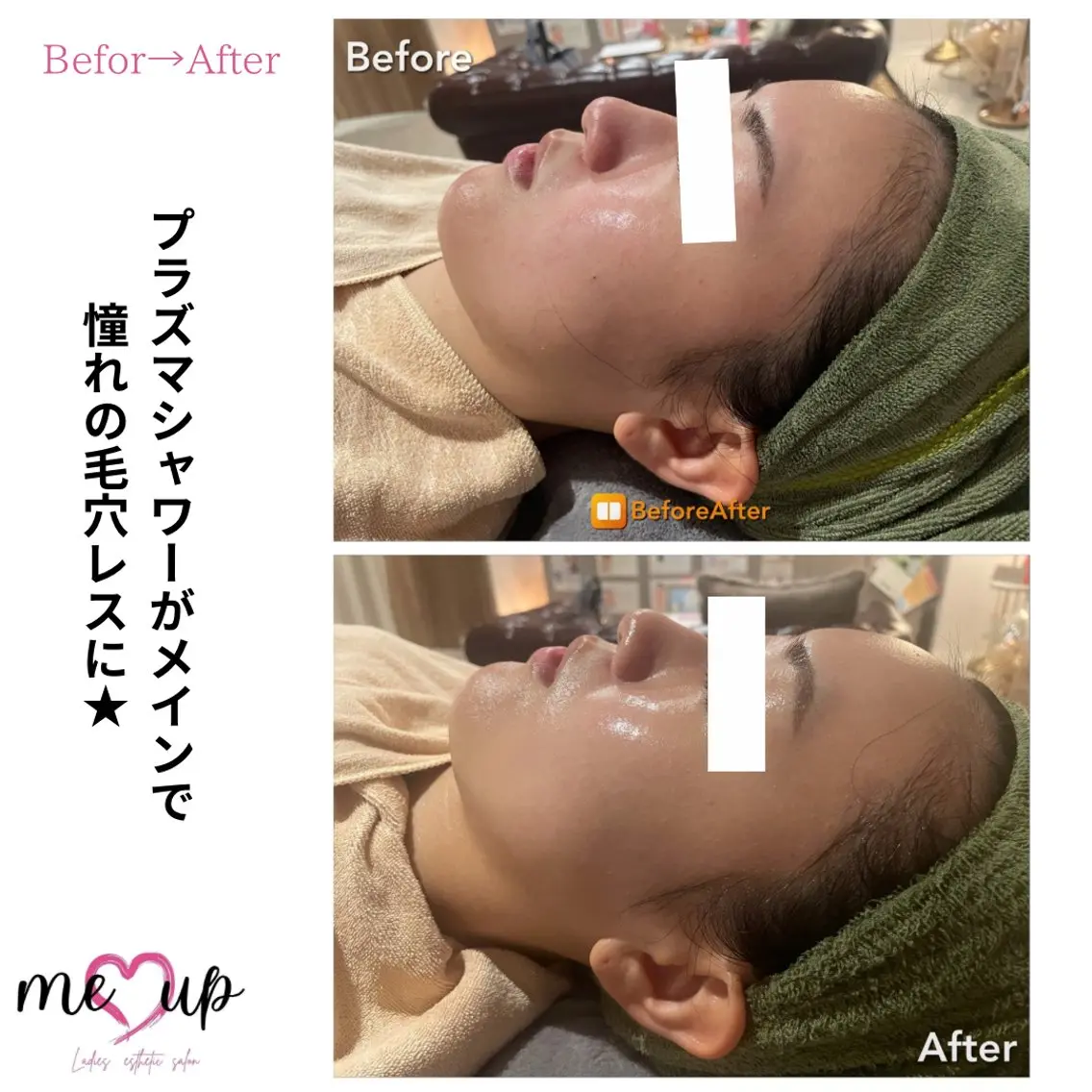 エステ Meupニキビ専門店 背中/ハーブ/肌管理のその他イメージ