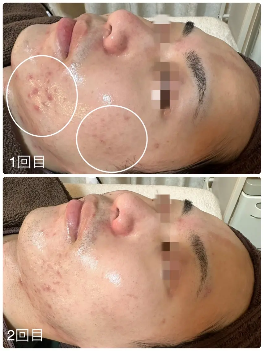 【メンズ】【モニター/ニキビケア】水光プラズマでニキビの素のアクネ菌を殺菌!赤ニキビ、凸凹肌におすすめです。の写真