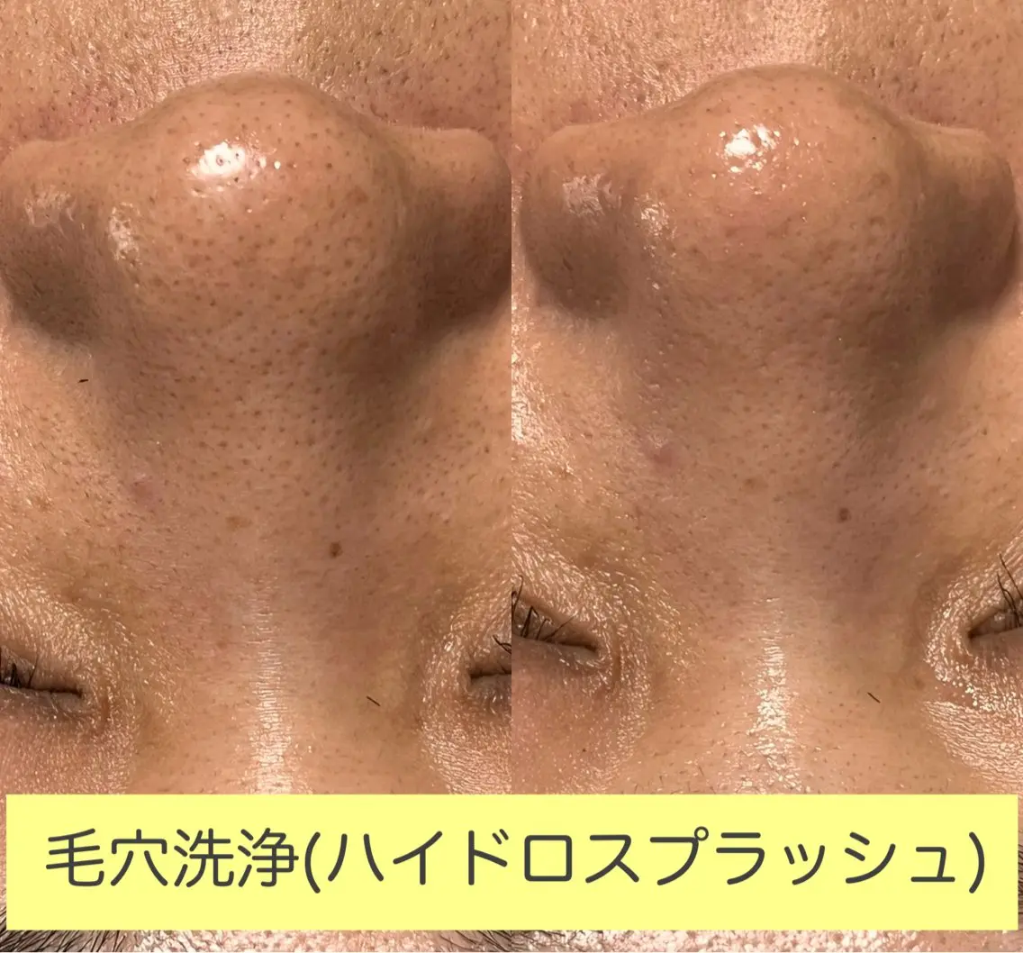 エステ 毛穴洗浄🍀脱毛🍀 光フェイシャル🍀のエステ・リラクイメージ