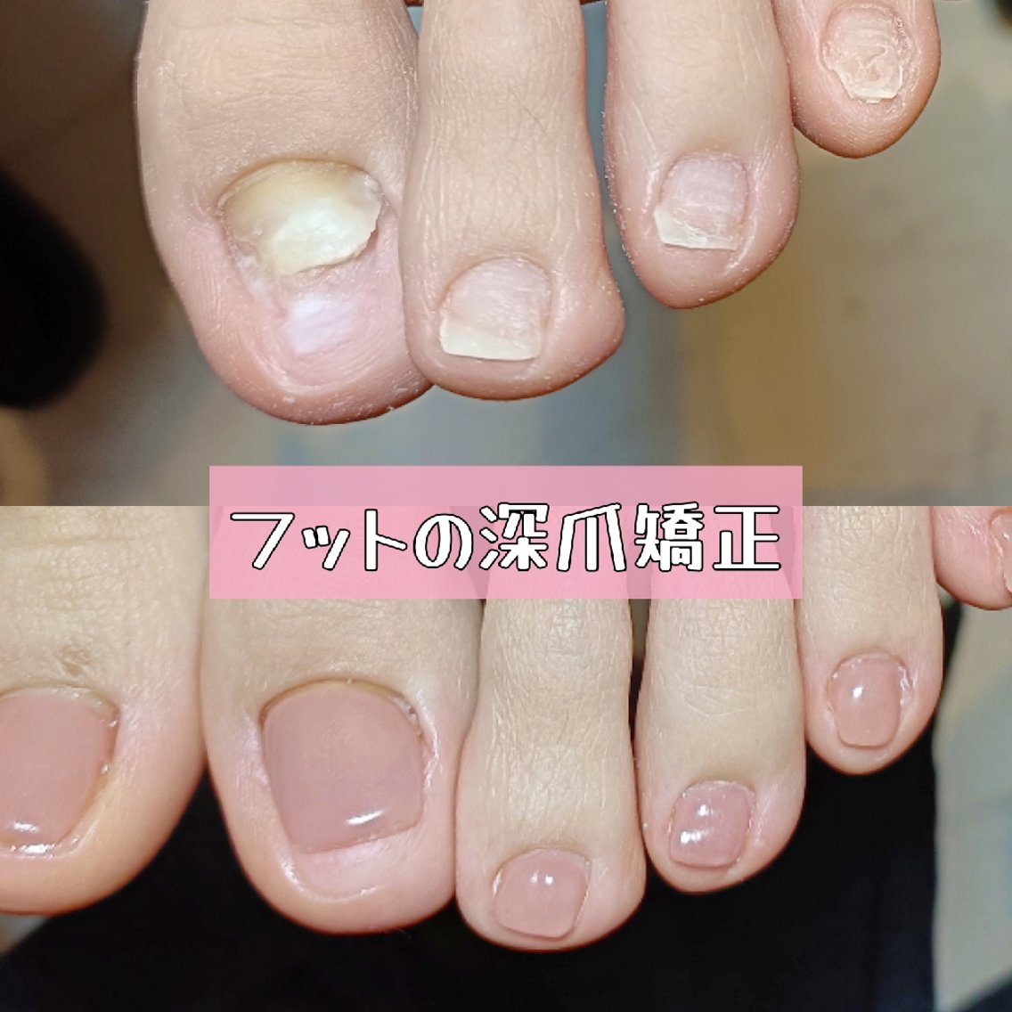 ネイル フットネイル フットネイル 深爪矯正/爪育成ケア manie nailのネイルデザイン