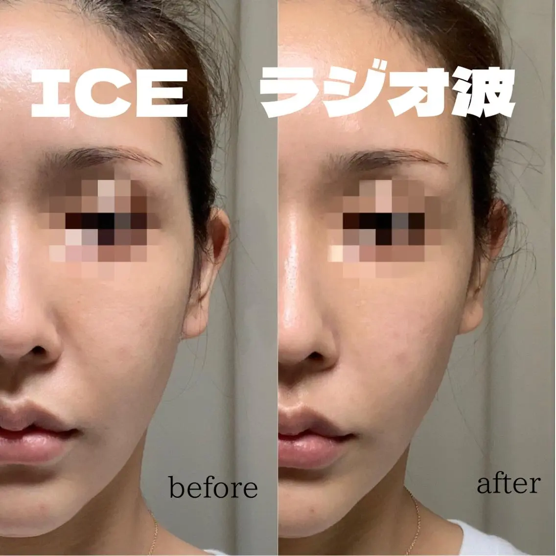 小顔!!リフトアップ!🧖♀️【ICEラジオフェイシャル40分】ハリツヤup※当日はお化粧をせずお越しください。の写真
