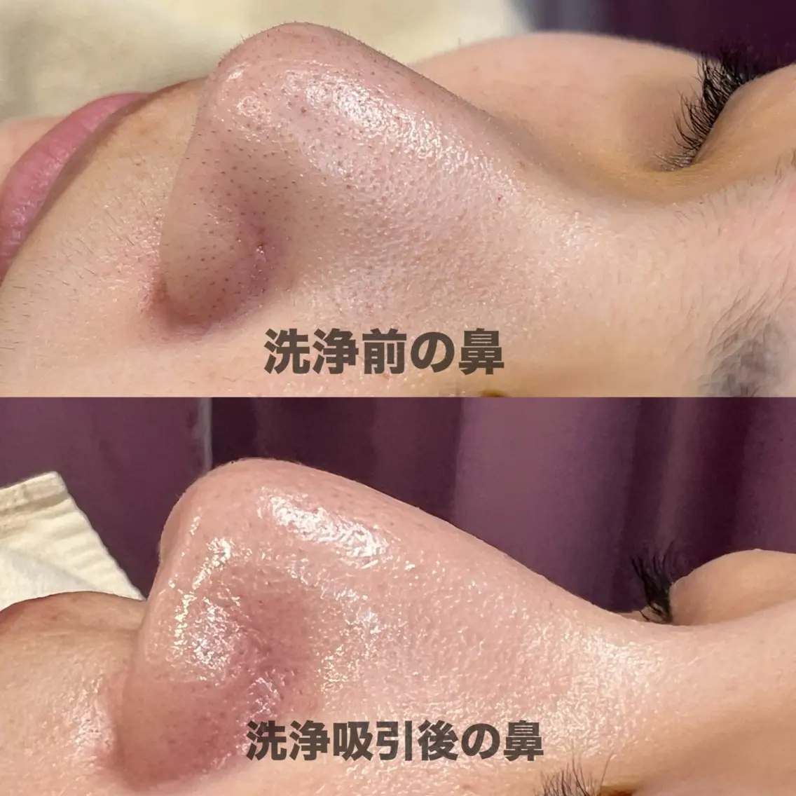 【🧼毛穴洗浄】顔剃り+小鼻洗浄+拭き取りパック✨の写真