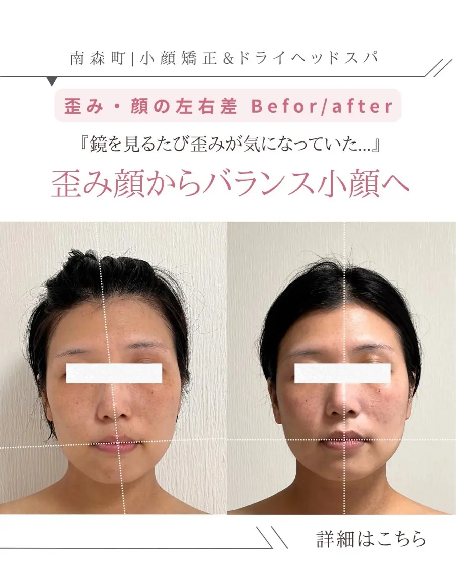 🌿 30代限定 3ヶ月間(6回来店条件)90分【顔の左右差解消/首や頭のねじれ解消小顔ヘッドスパ】の写真