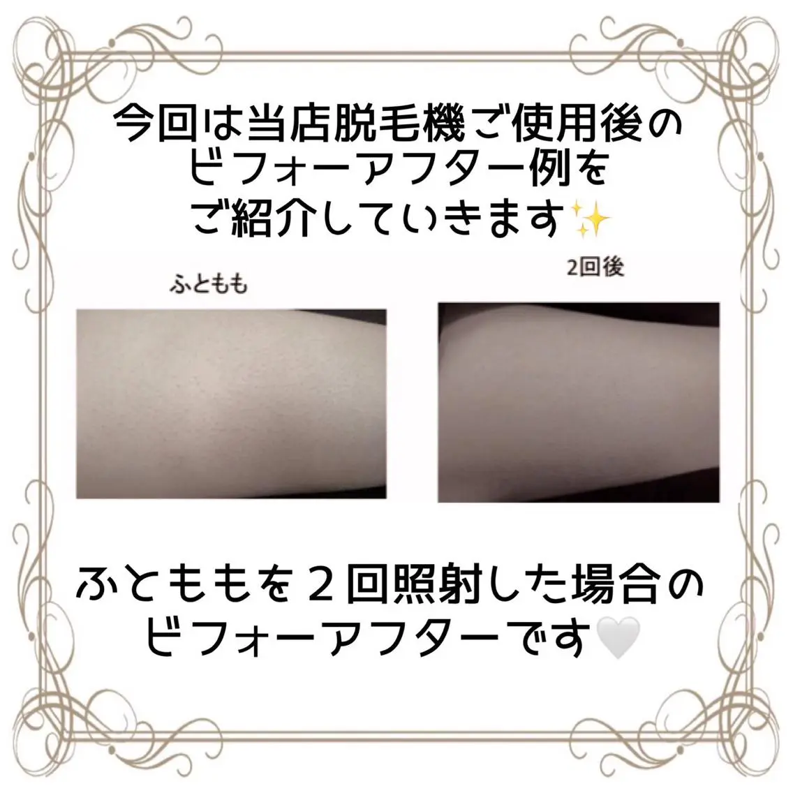 脱毛 セルフエステサロン BATONのエステ・リラクイメージ