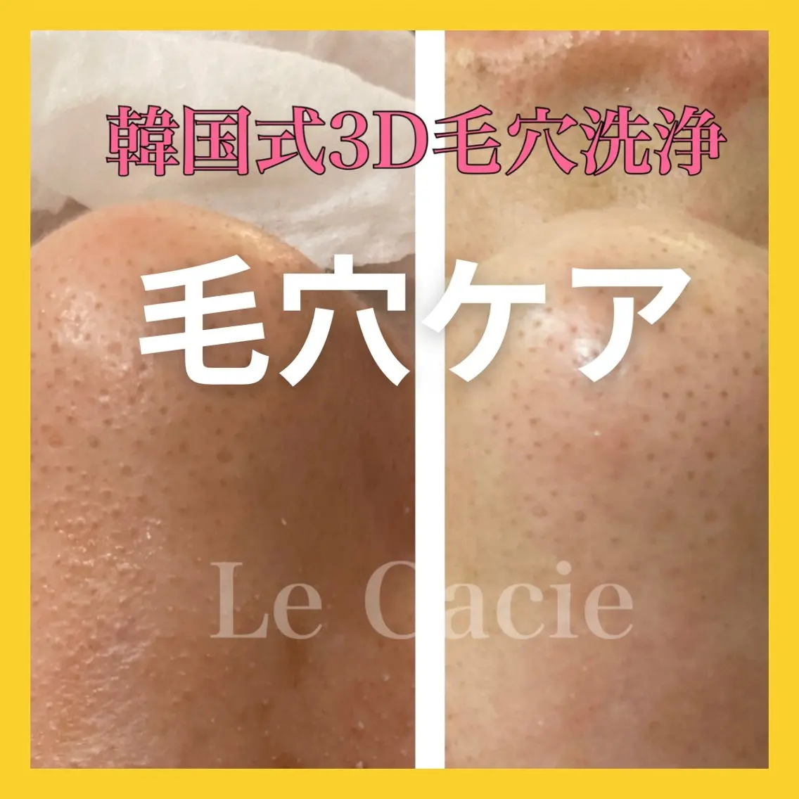 韓国3D毛穴洗浄★小鼻の黒ずみ、毛穴目立ちに!ニュルっとスポッと皮脂を除去しますの写真