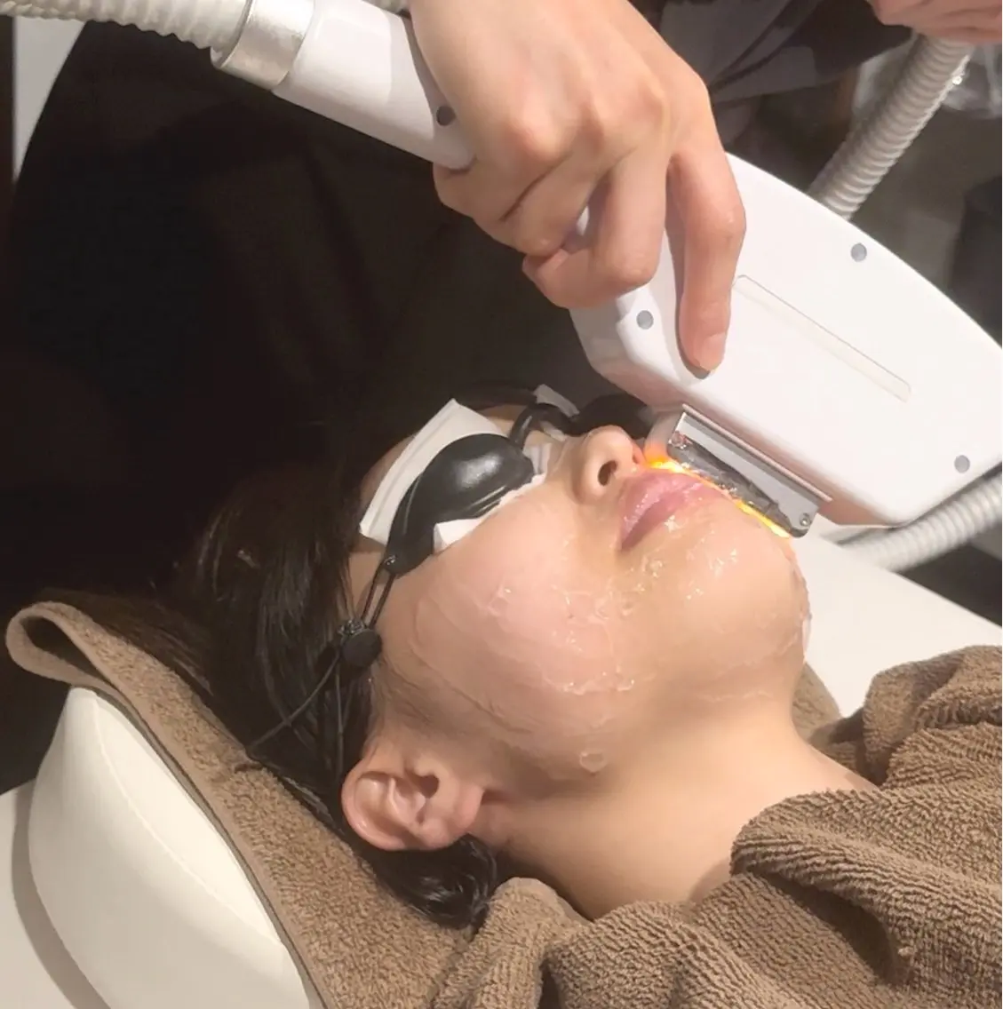 レディース顔脱毛+毛穴ケアの写真