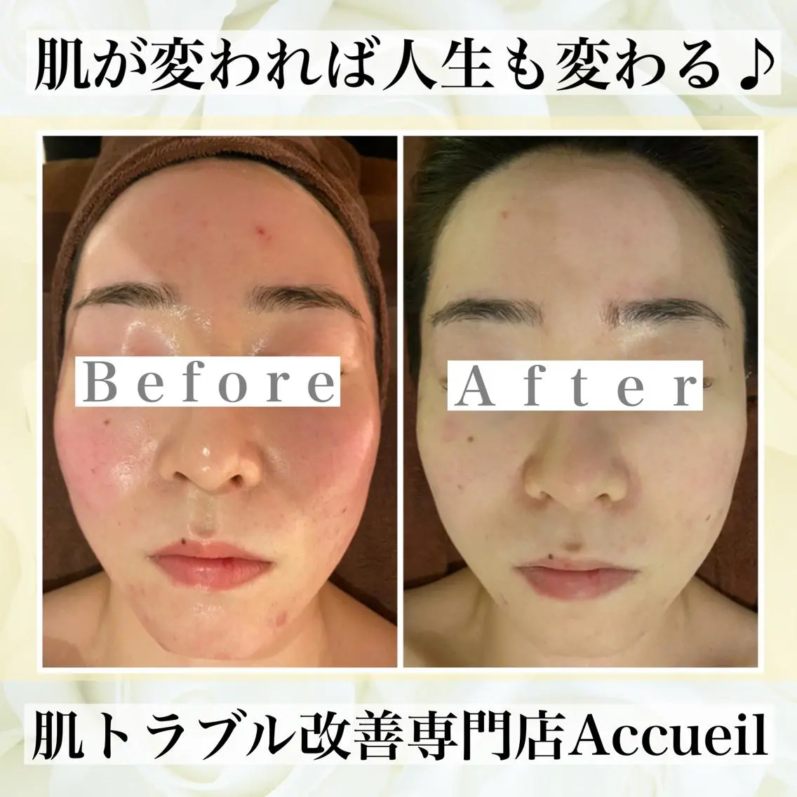 ミディアム カラー パーマ ヘアアレンジ メンズ キッズ ネイル マツエク・マツパ エステ リラク ニキビ・肌質改善専門 ♡人生が変わるサロンのエステ・リラクイメージ