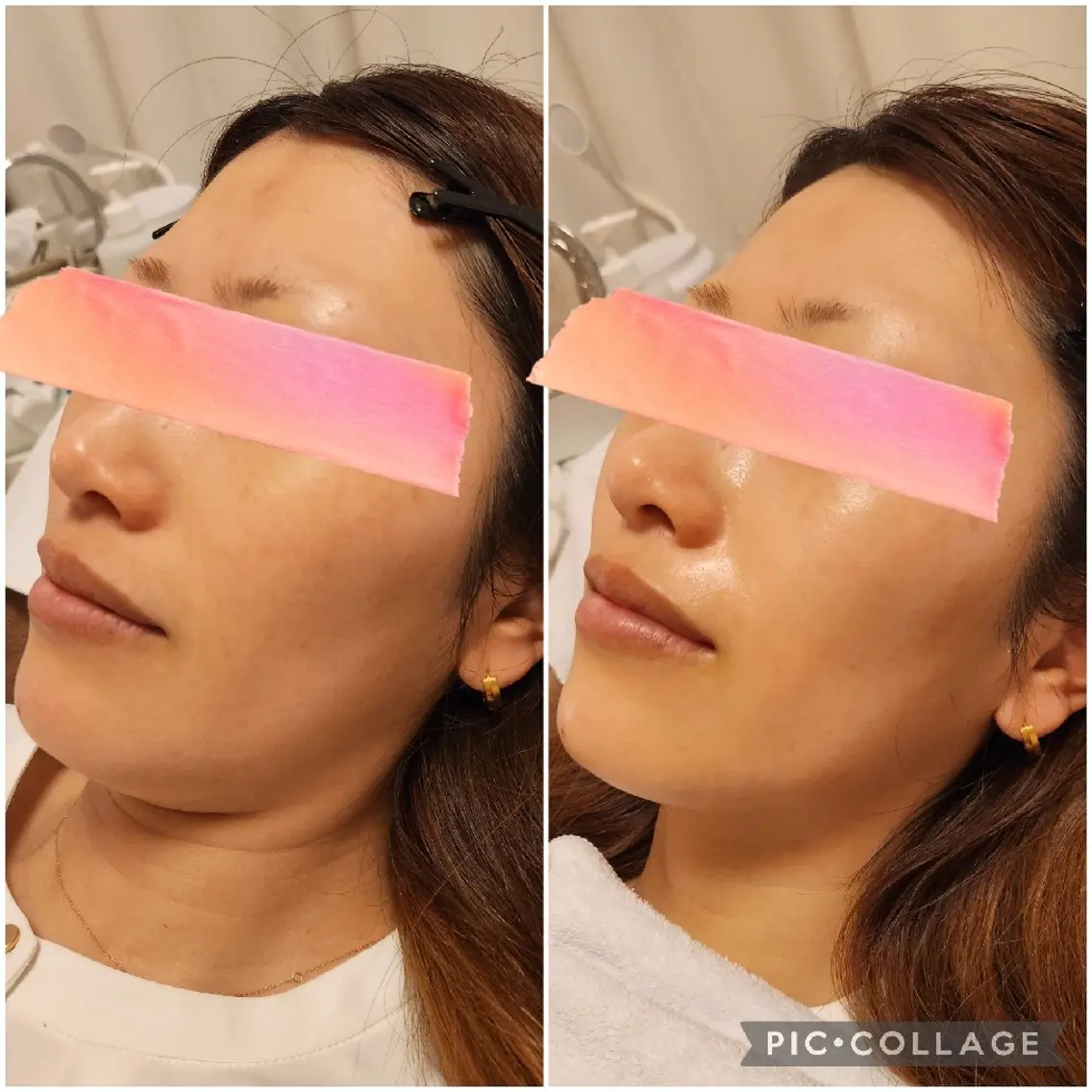 お肌を格上げ☆フェイシャル超音波エステの写真