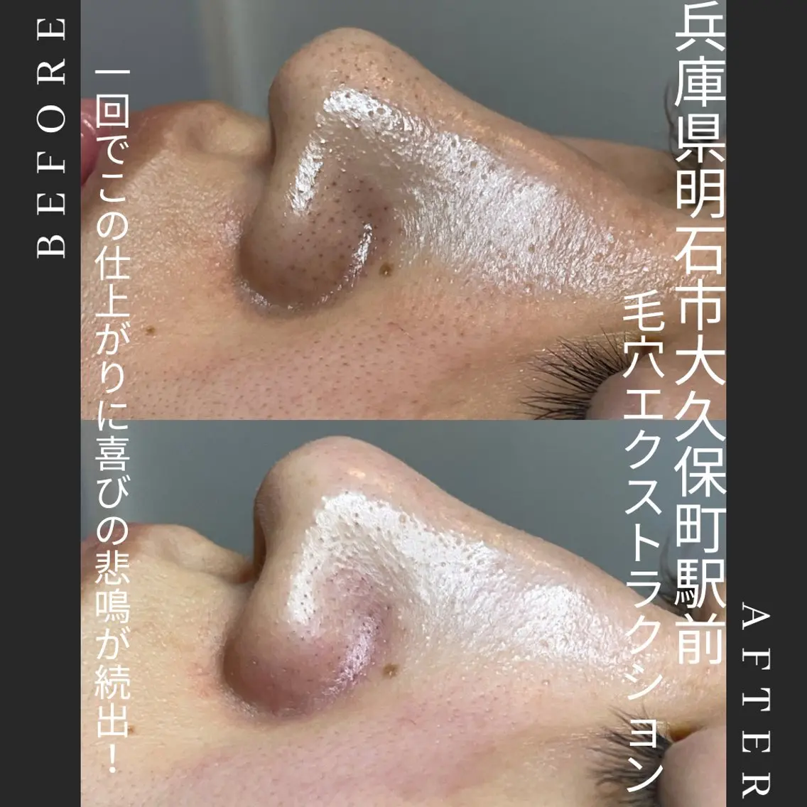 🌱初回限定。毛穴エクストラクション全顔(光フェイシャル付き)メンズも施術可能🉑の写真