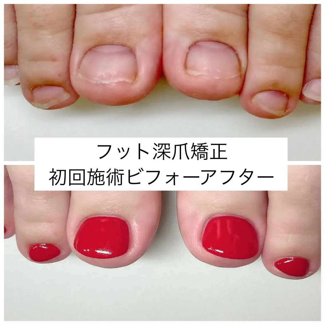 ミニモ限定🦶【むしり癖・でこぼこ爪】🌿フット深爪矯正《ケア＋長さ出し＋ワンカラー仕上げ》の写真