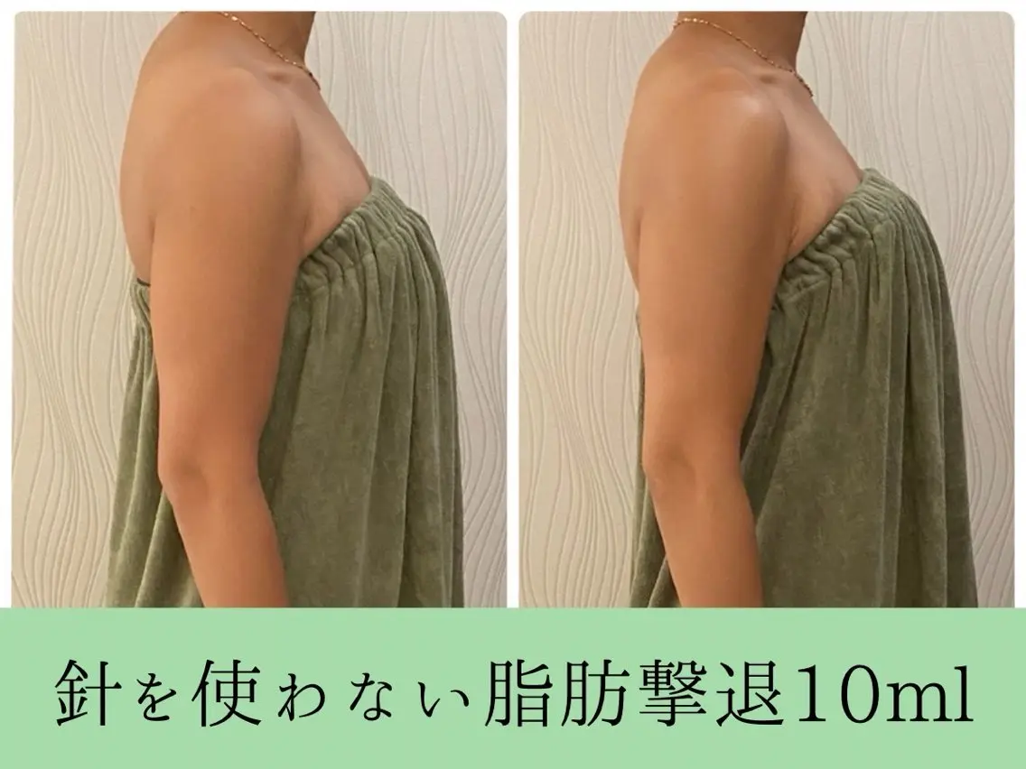 ☘️新春モニター☘️残5名様🌸針を使わない脂肪撃退🌸後戻り0🙆‍♀️お好きなお身体1部位¥39600⇨¥9500の写真