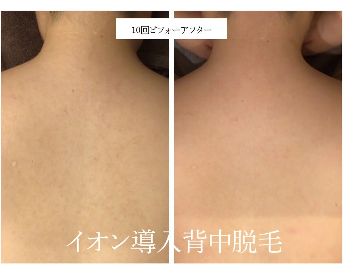 脱毛 🎀うなじ脱毛🎀 ㅣLino堀江のエステ・リラクイメージ