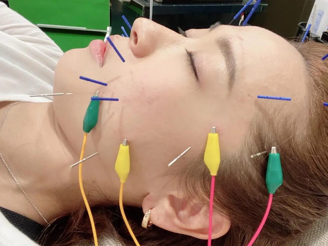 Grace face❤️美顔鍼 『美容鍼+パルス(電気鍼)』の写真