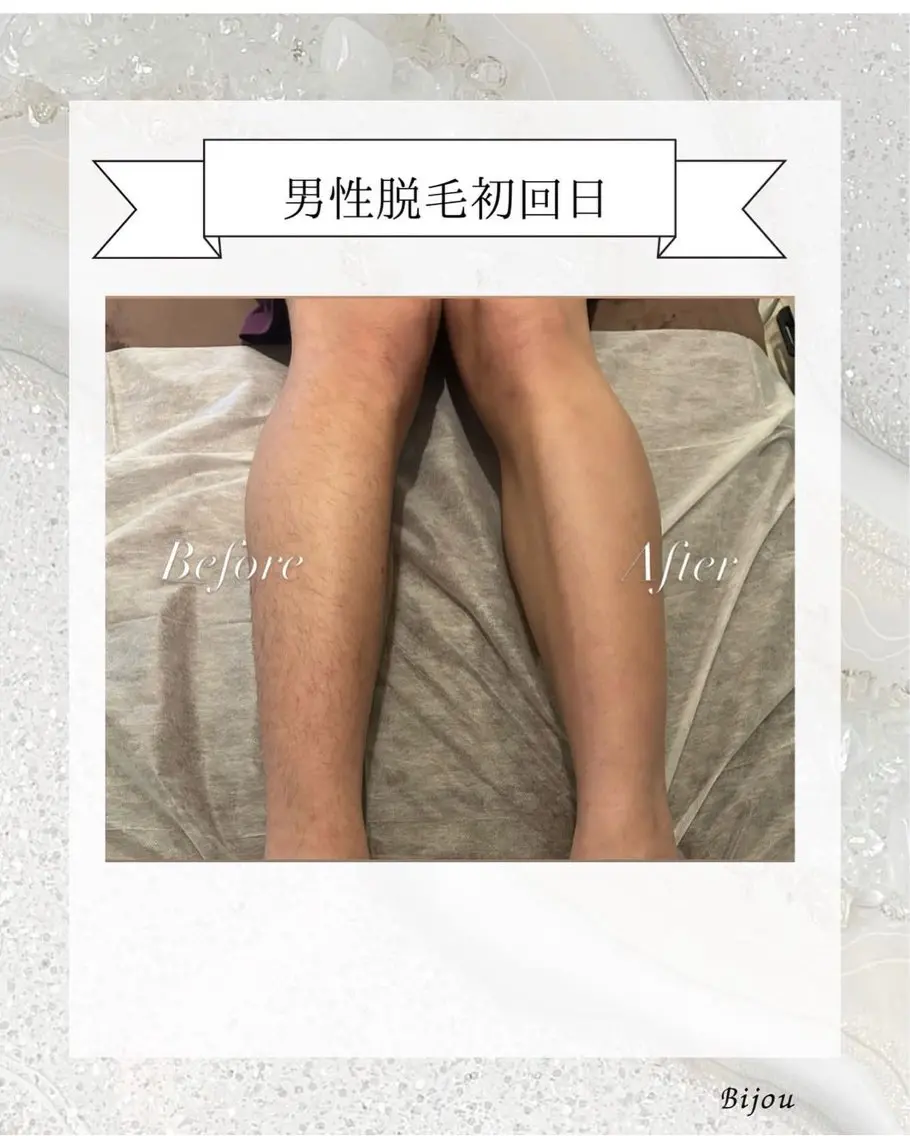 新規様　初回男性🚹全身脱毛9.000円の写真