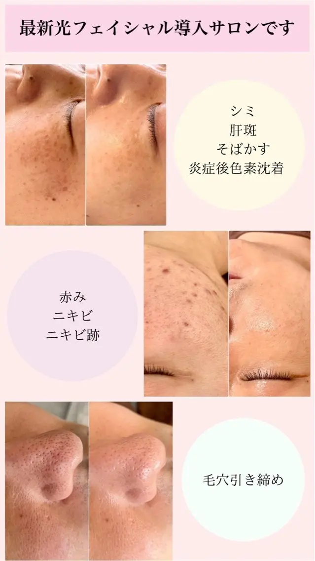 光エステでシミ取り肌質改善！の写真