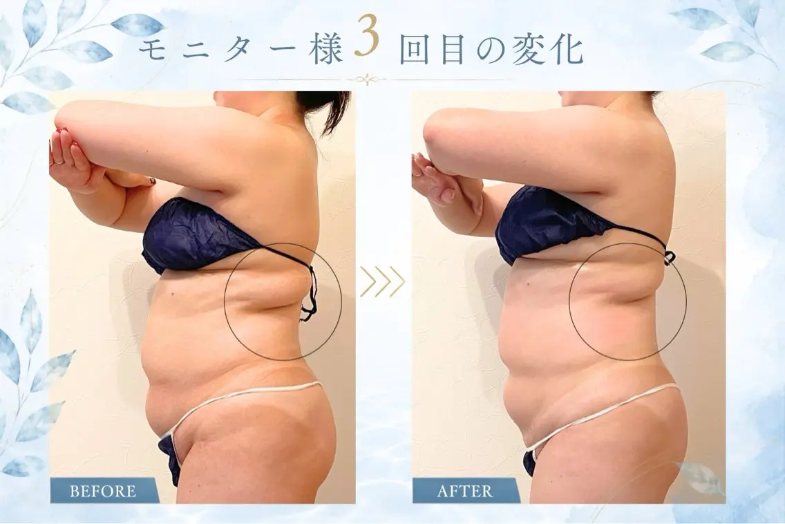 【ぽっこりお腹・背肉ケア】上半身集中ケア体験60分 通常価格¥26,400の写真