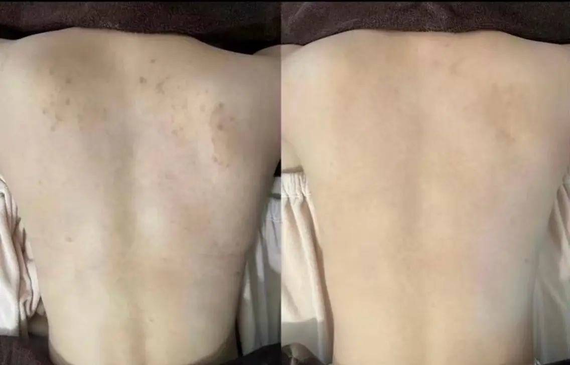 モニター様募集💎【背中全体】剥離ありハーブピーリング🌿ニキビ・ニキビ跡・毛孔性苔癬・色素沈着の写真