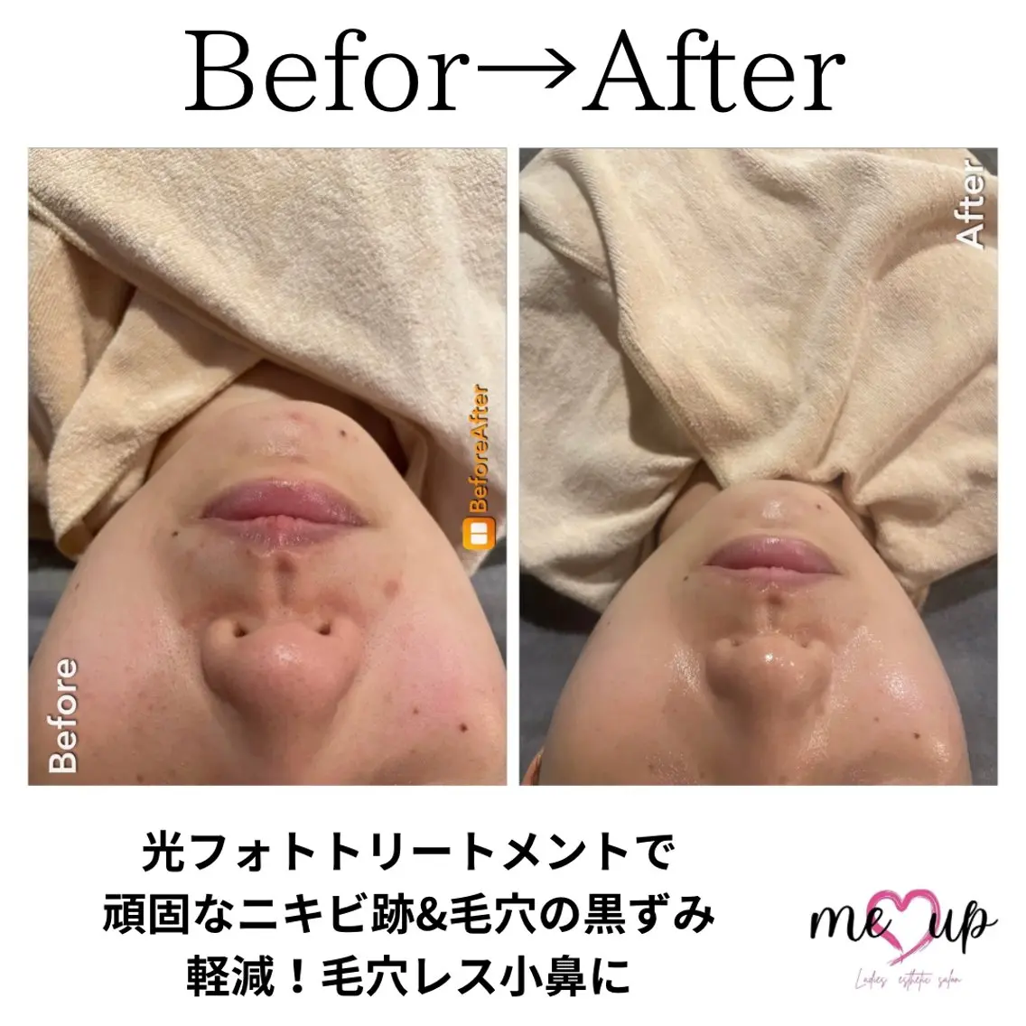エステ Meupニキビ専門店 背中/ハーブ/肌管理のその他イメージ
