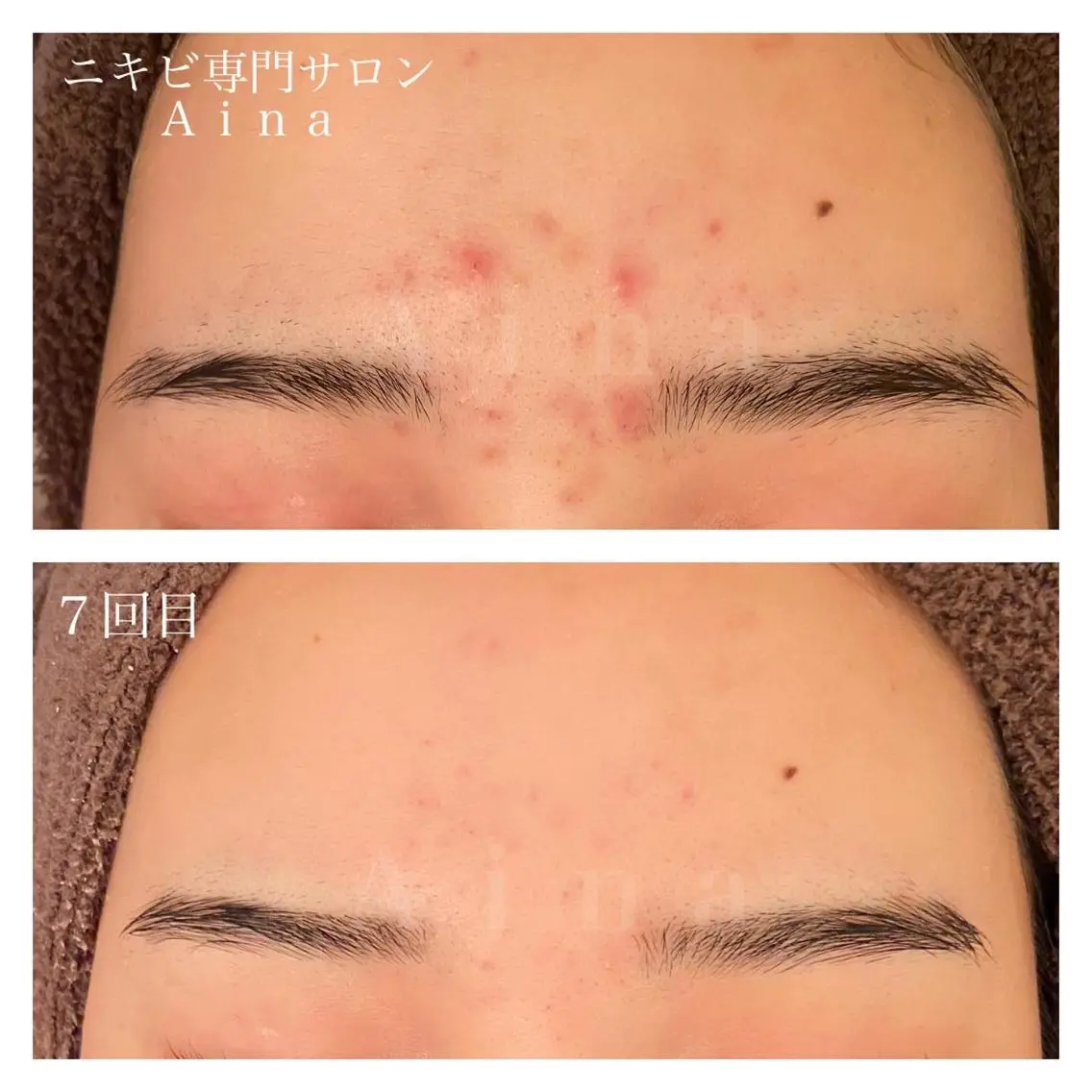 セミロング パーマ ヘアアレンジ メンズ キッズ ネイル マツエク・マツパ 卒業式のヘアスタイル 卒業式 赤色 ニキビ跡専門サロン Ａｉｎａのエステ・リラクイメージ