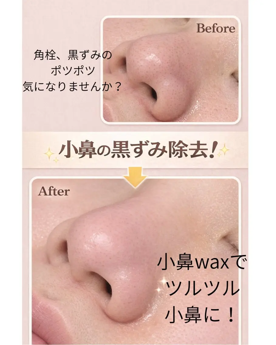 鼻の黒いポツポツ!👃鼻毛waxと小鼻角質除去wax、パック付の写真