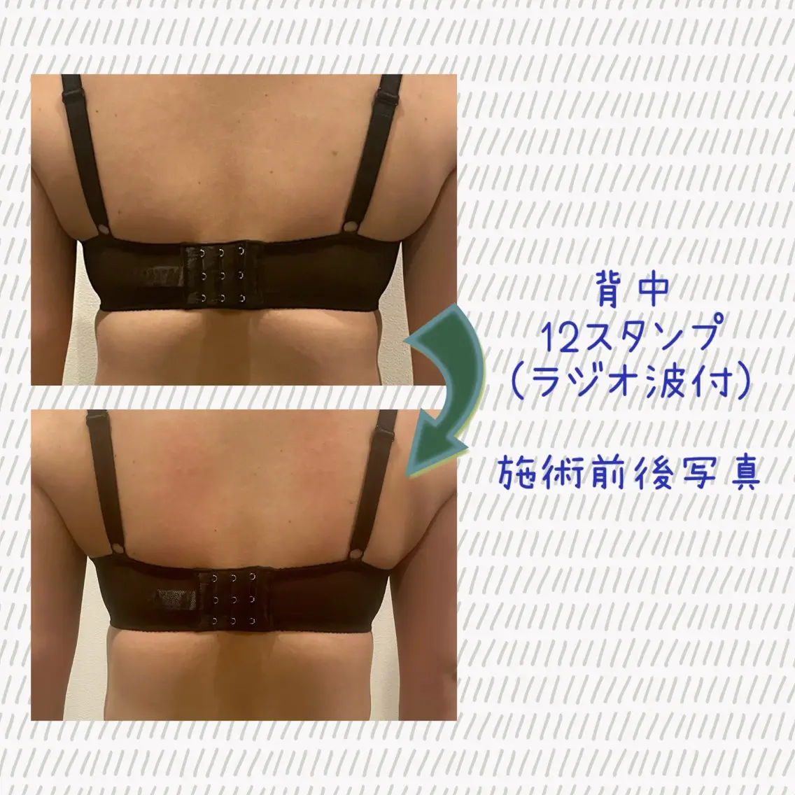 【ブラはみ肉/ブライダル】背中痩身フルコース　12スタンプ＋ラジオ波30分付の写真