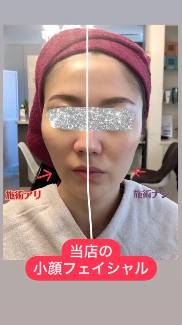 スプリングキャンペーン🌸一番人気！小顔リフトアップオールハンドフェイシャルの写真