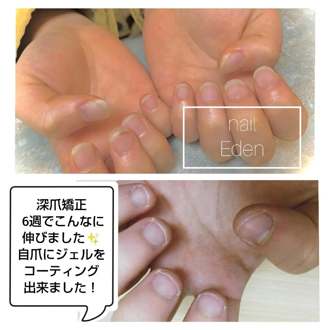 【深爪矯正】噛み癖・むしり癖・自爪がなかなか伸ばせない方必見❣️長さ出しクリアコーティングお仕上げ#自爪育成の写真