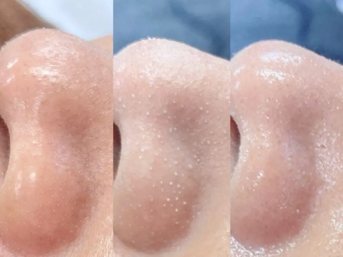 【毛穴洗浄】ハイドロディープクレンジング/小鼻の黒ずみ集中ケアの写真