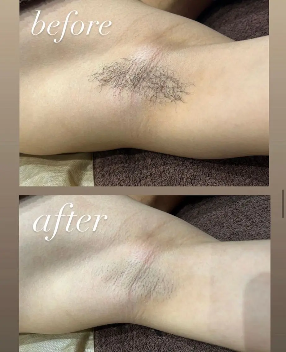 学生様限定★ 男性も女性も◎ワキ&腕脱毛 卒業まで何回でも4000円/回の写真
