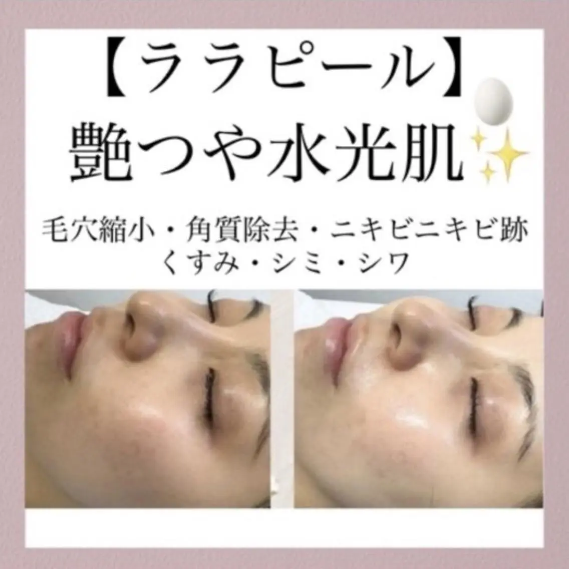 モエ ｜青葉台 脱毛のエステ・リラクイメージ