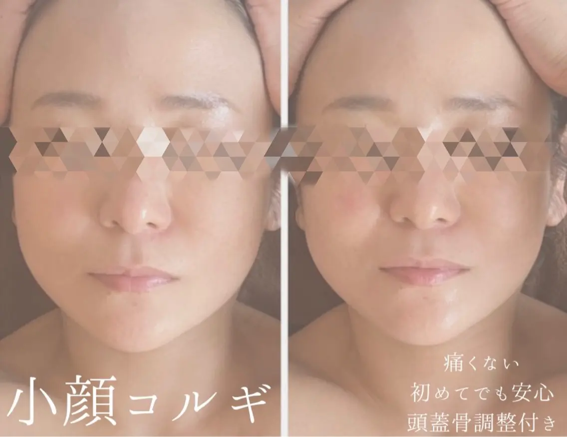 【即小顔/ *むくみスッキリ】痛くない!オーダーメイド小顔コルギ(鎖骨〜頭蓋骨まで施術)75分¥7.900の写真