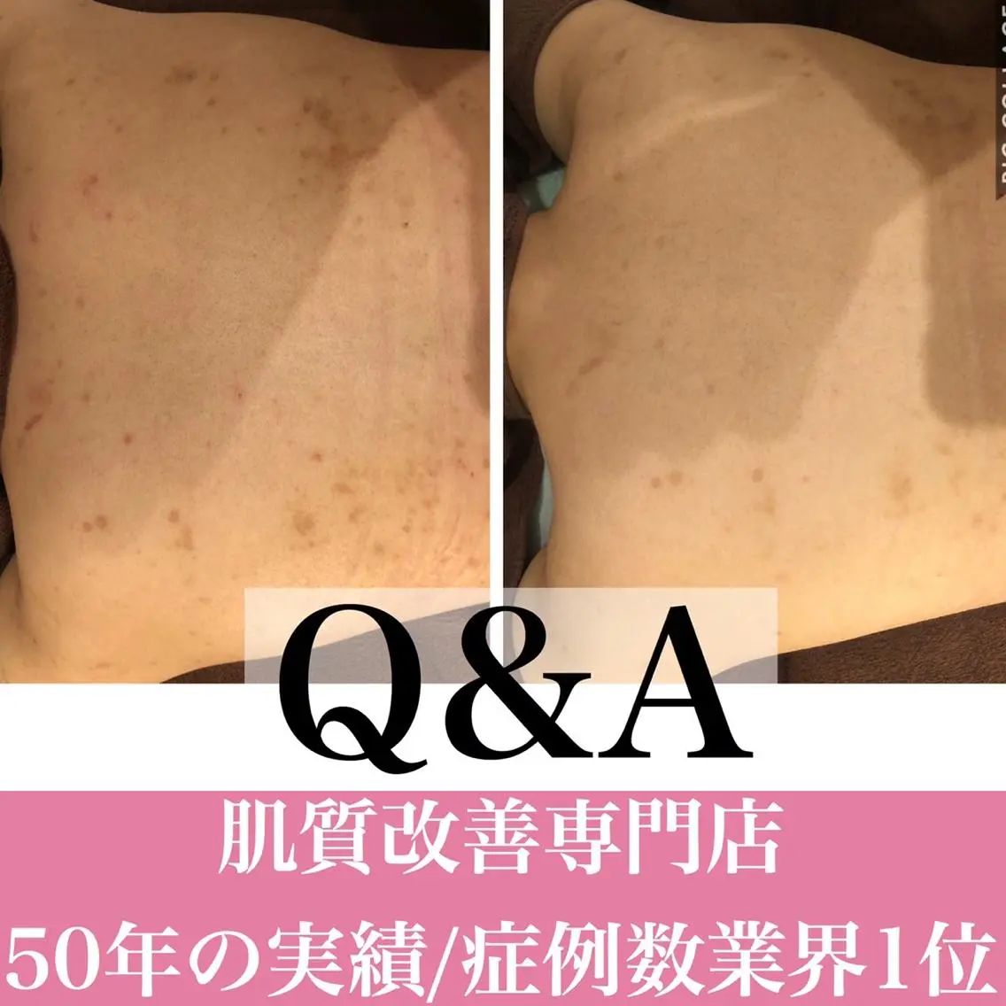 ミディアム カラー パーマ ヘアアレンジ メンズ キッズ ネイル マツエク・マツパ 学生(メンズ向け) 学生 エステ リラク ニキビ・肌質改善専門 ♡人生が変わるサロンのエステ・リラクイメージ