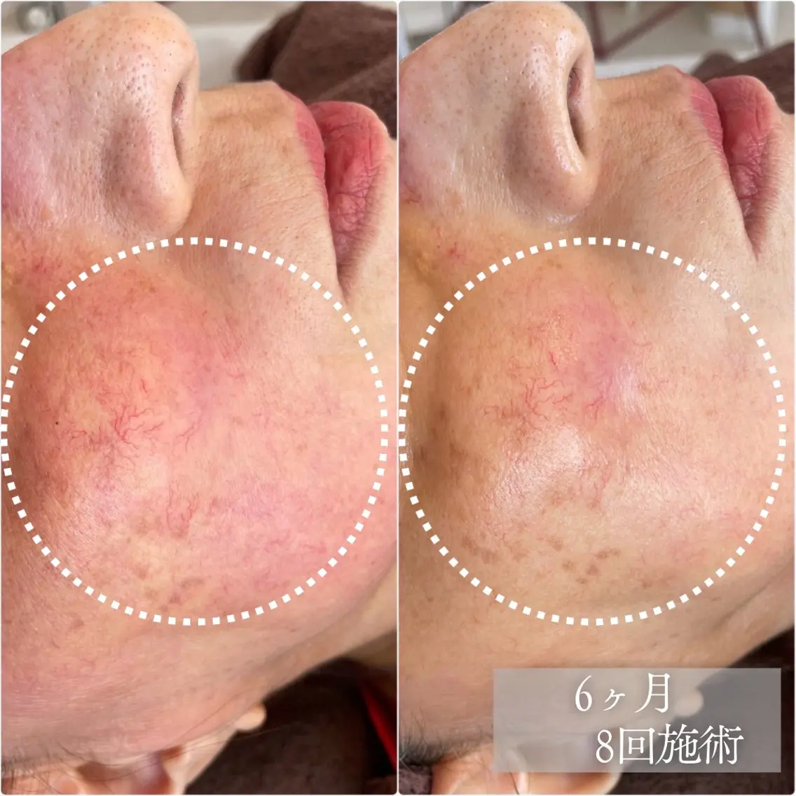 【肌荒れ•ゆらぎ肌に】艶肌ジュエリーピール＋毛穴洗浄で肌荒れケア　ヘッドスパ＆首肩デコルテトリートメント付きの写真