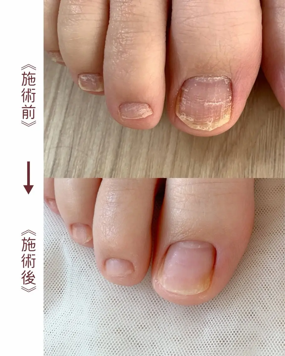 ネイル フットネイル ハルファム さやのネイルデザイン