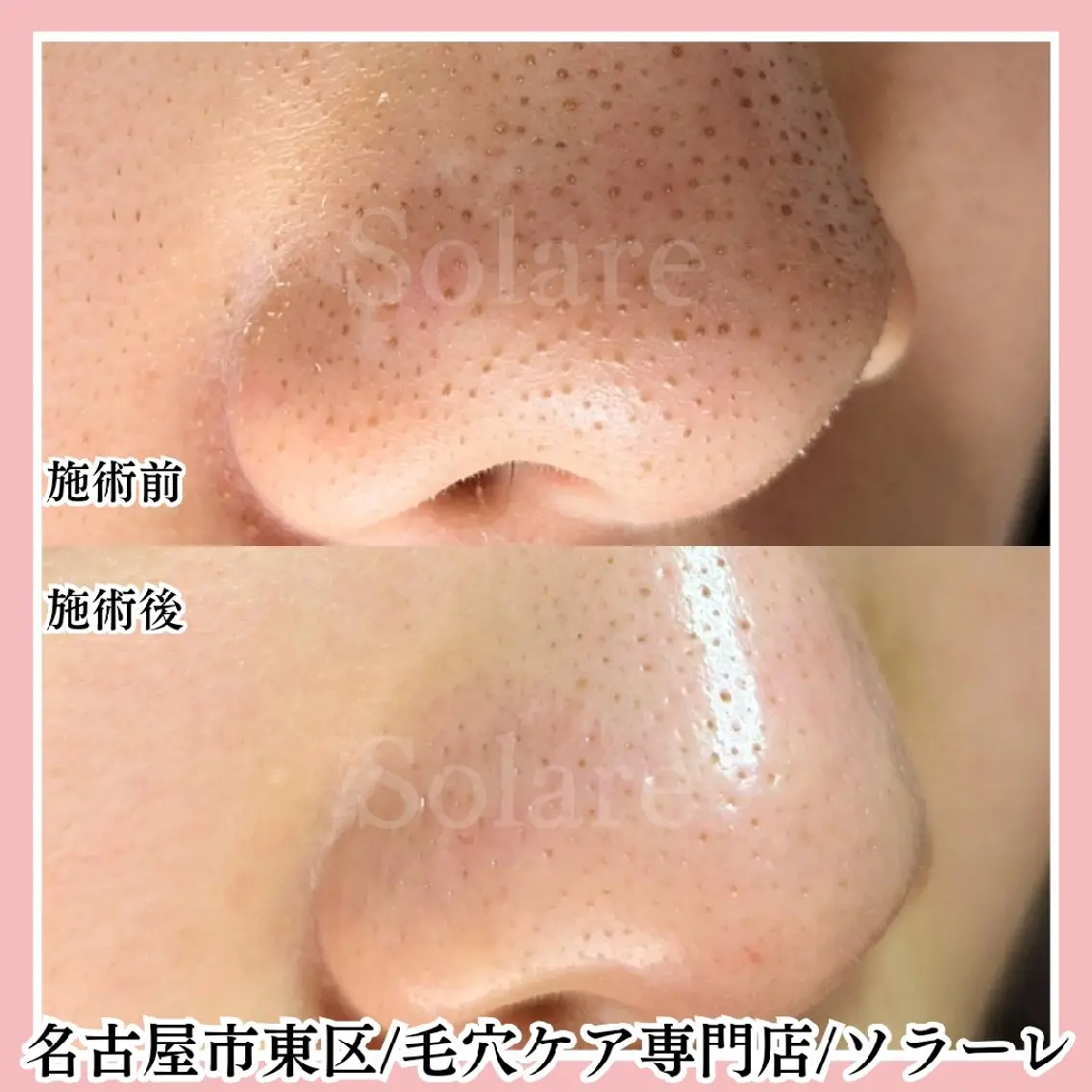 毛穴の汚れを根こそぎ洗浄＋フェイシャル＆ヘッドマッサージの写真