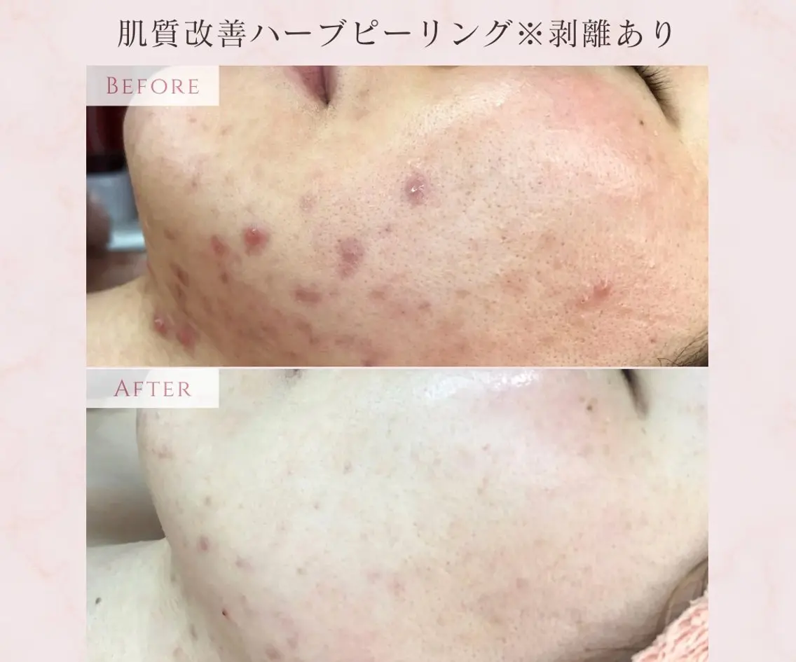 【ミニモ限定価格❤️‍🔥】【結果で選ばれる】肌質改善ハーブピーリング（顔)※剥離あり¥22,000→¥13,000の写真