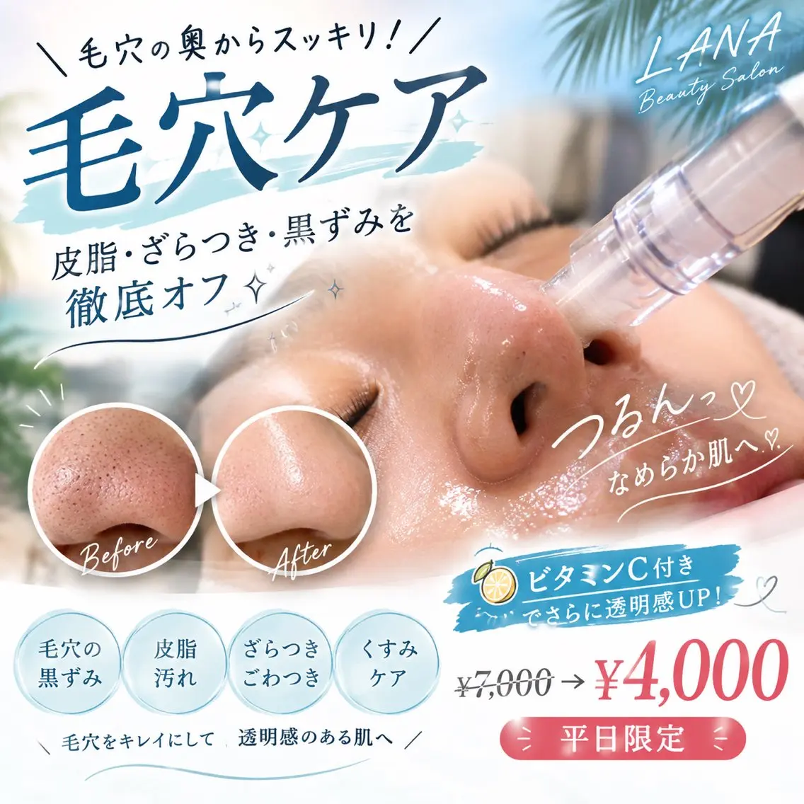 【毛穴・皮脂・ざらつきケア✨】鼻パック＋ビタミンC付き¥7000→¥4000の写真