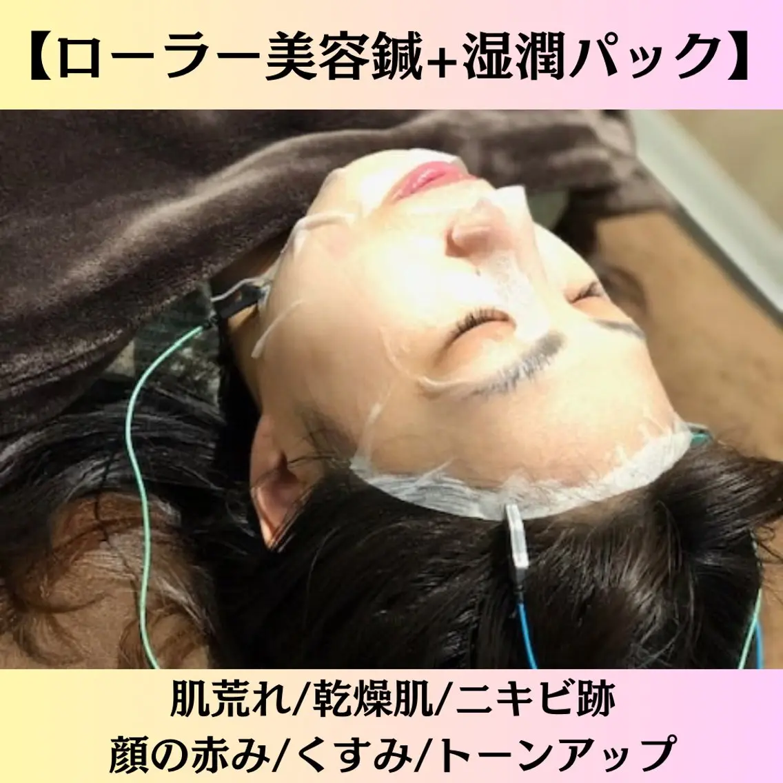 肌質改善美容鍼【初めての方はこちら】の写真