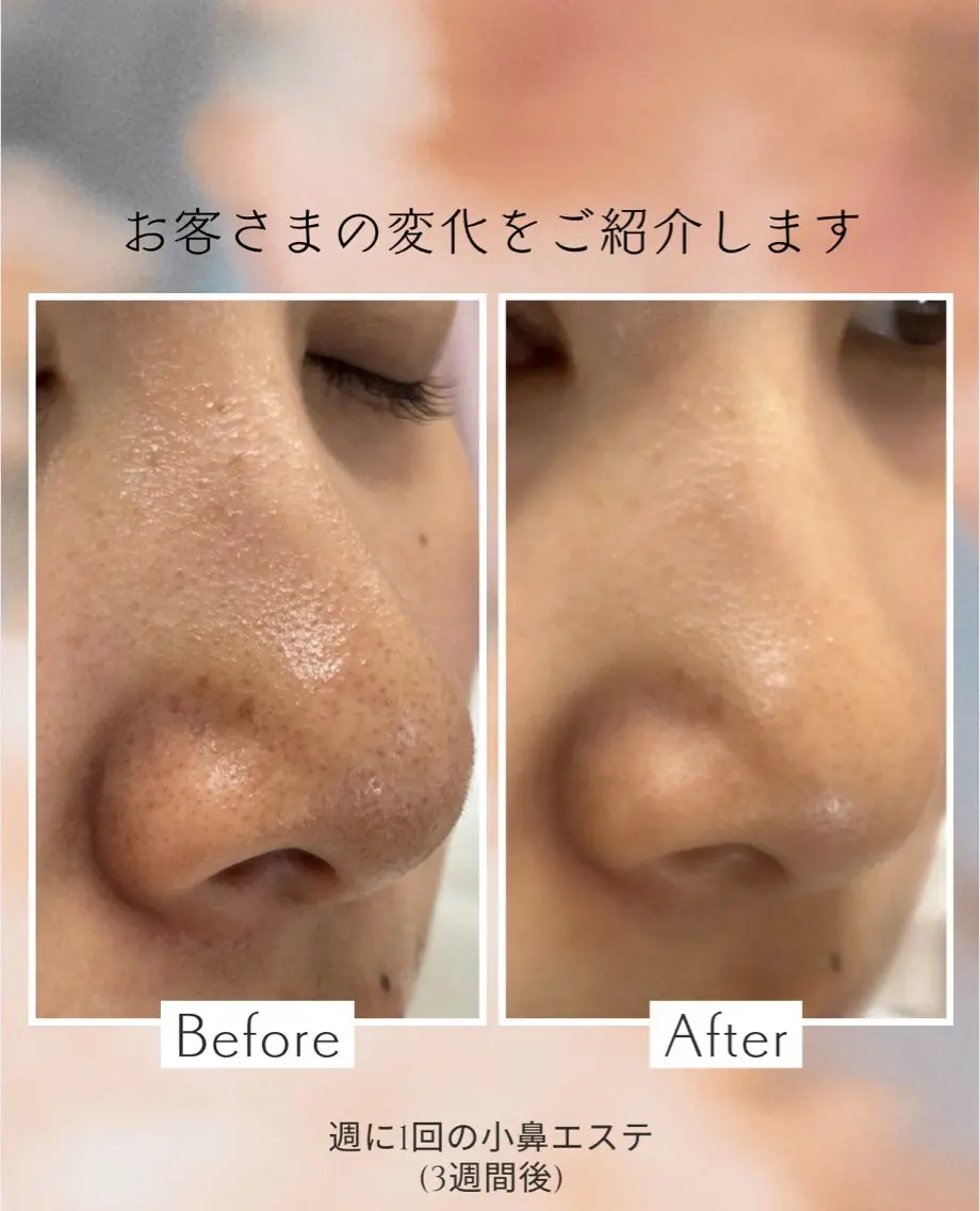 小鼻ツルツルエステの写真