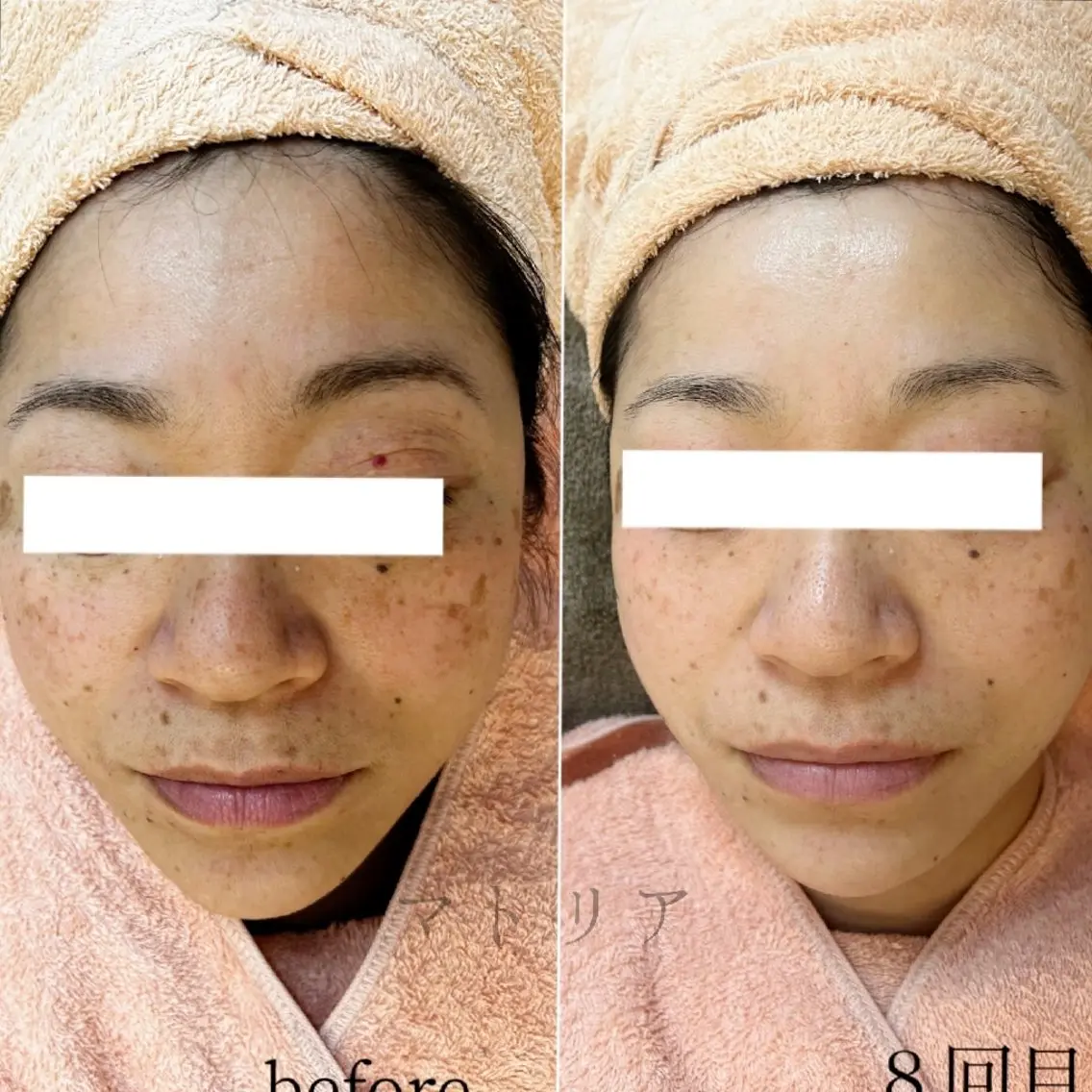 土台美容！年齢肌による、お悩みにアプローチの写真