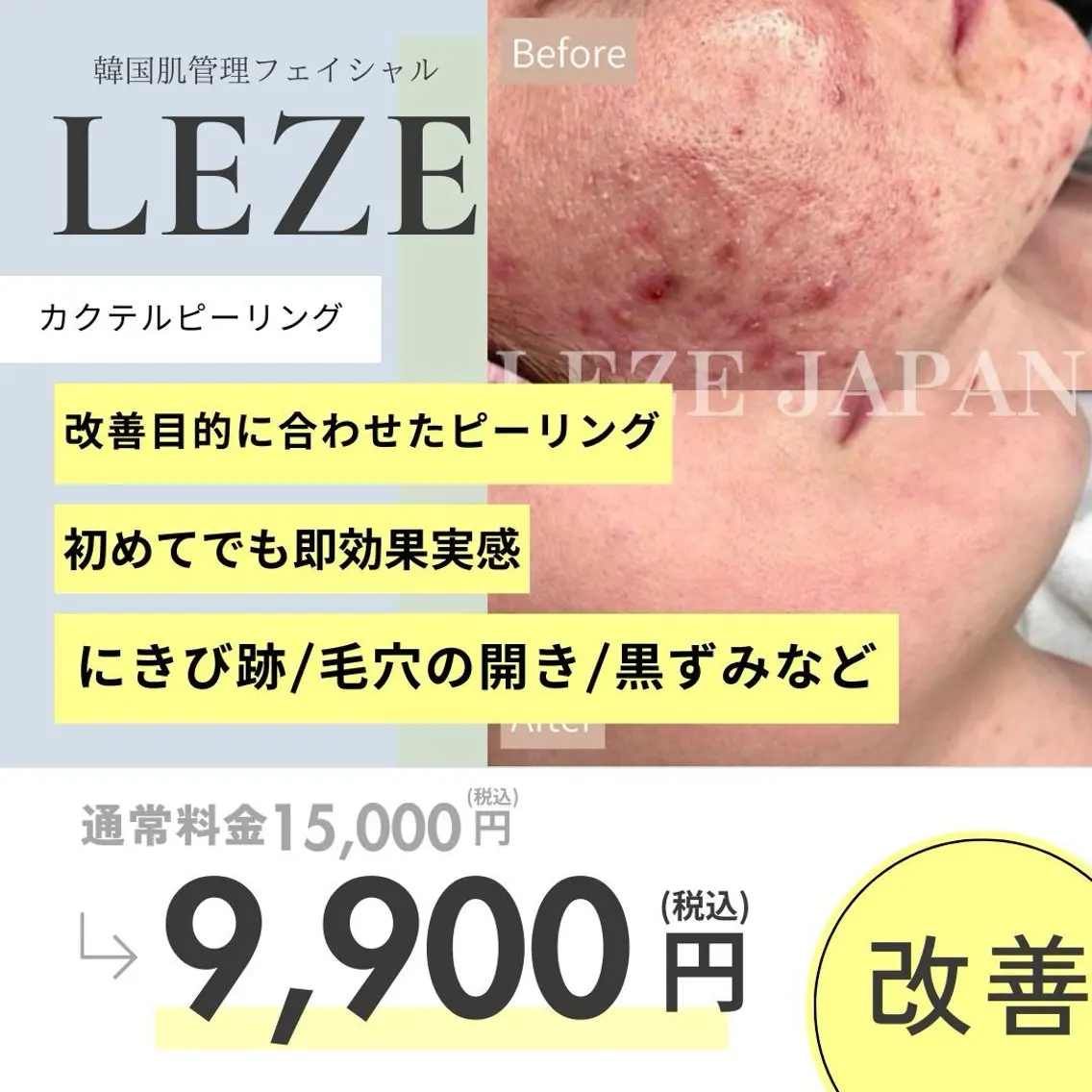 目指せ韓国肌ピーリング🇰🇷ホットペッパー新規¥9900→ミニモ限定¥8800の写真