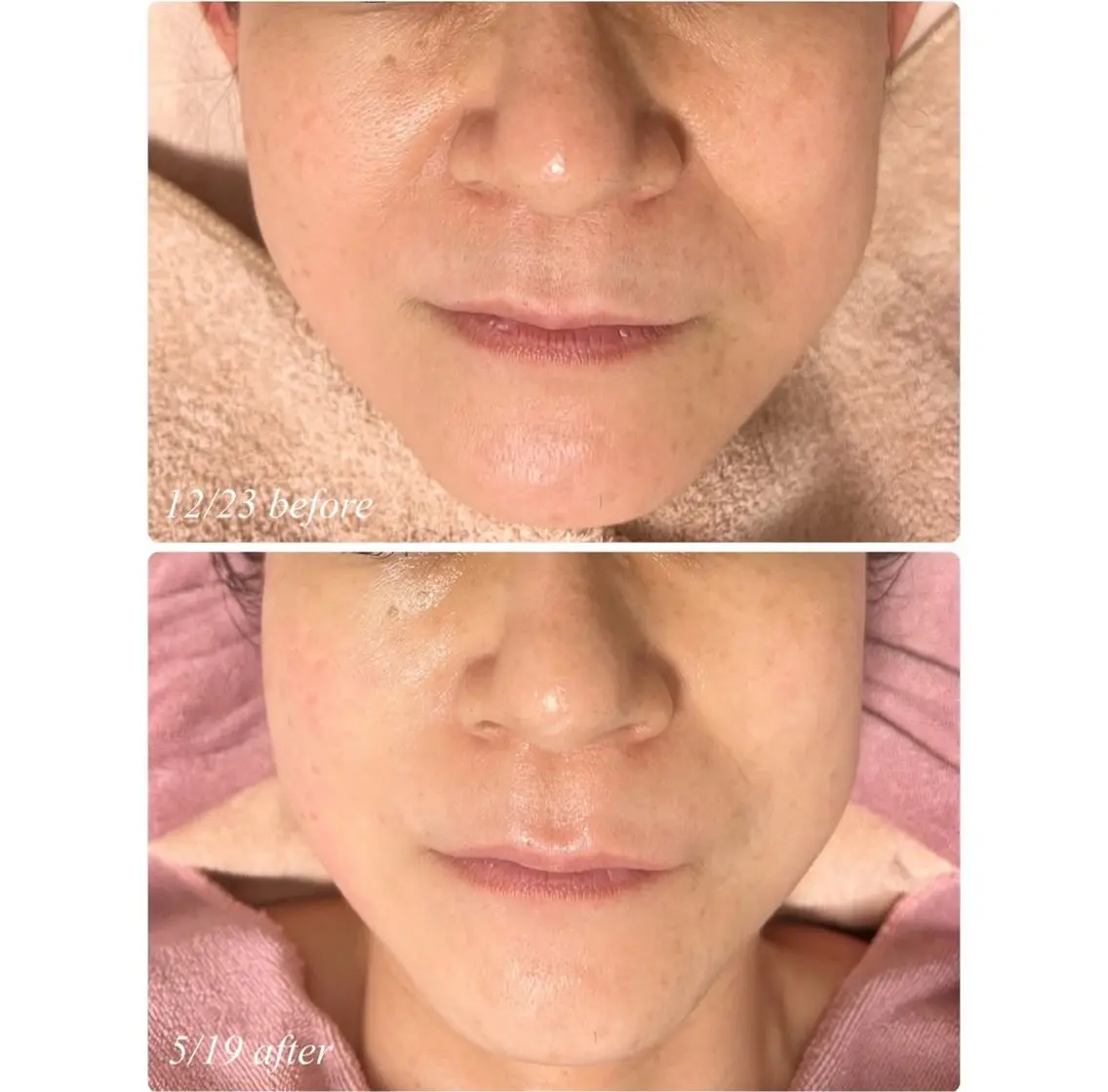 究極のリフトアップ5回コース❣️❣️FACE MAKE 4Dクリーム1本プレゼント🎁の写真