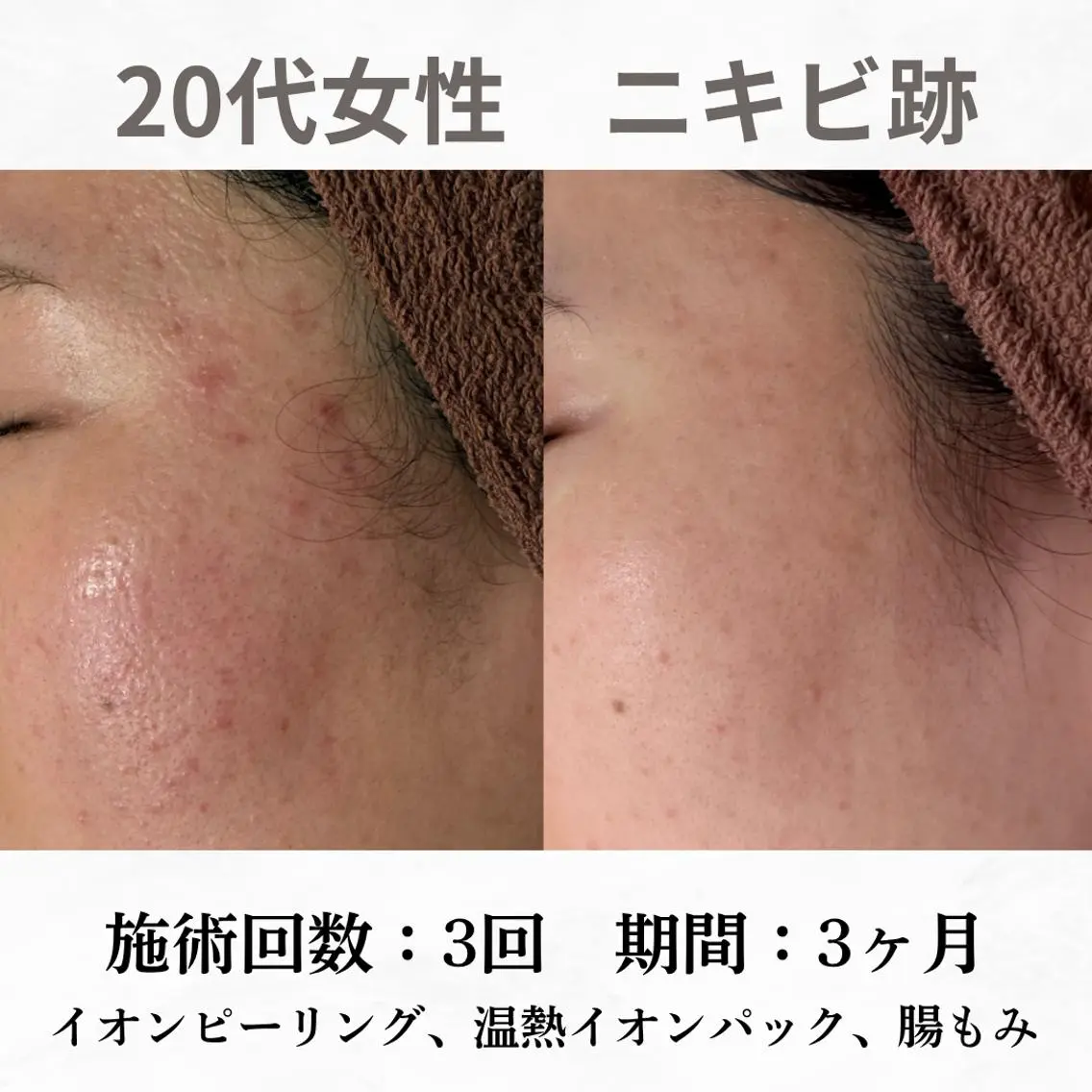 重度ニキビ専門🌷 ダウンタイムなしのエステ・リラクイメージ
