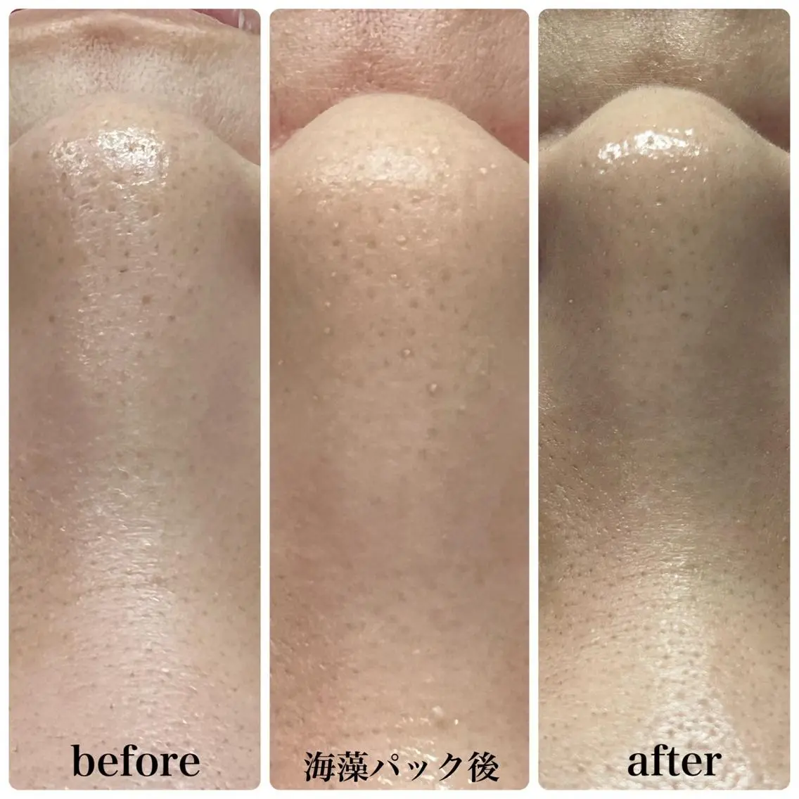 【平日限定/この春褒められる肌作り】全顔3D毛穴洗浄+顔無VIO込全身脱毛¥11,500の写真