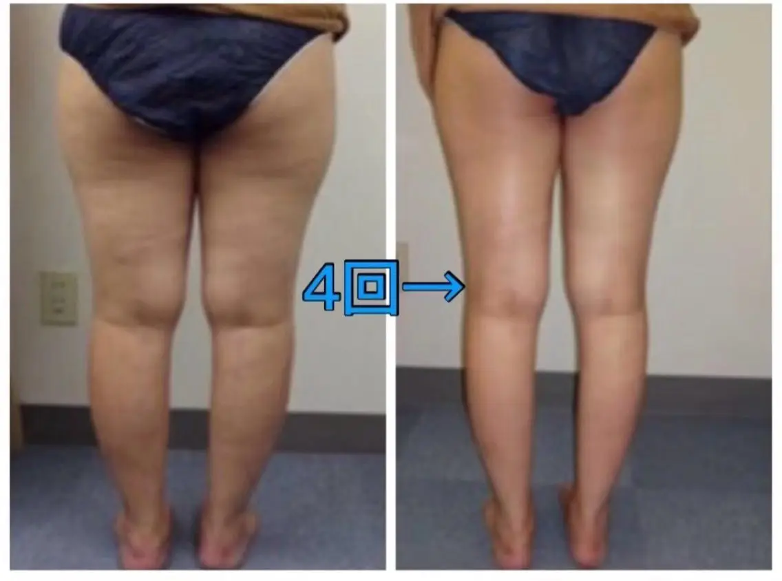 ❤️人気No1❤️キャビ痩身マシン+全身リンパ+ヘッドスパ120分の写真