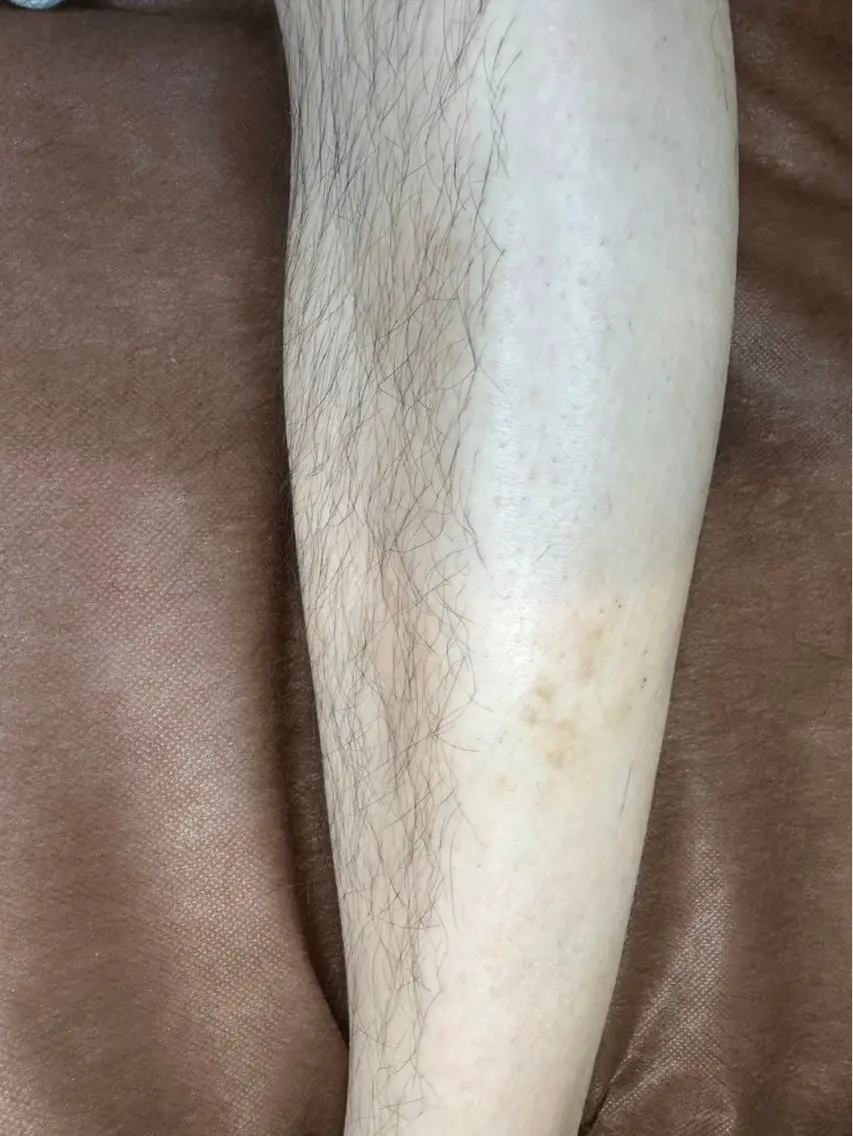 メンズ両腕脱毛の写真