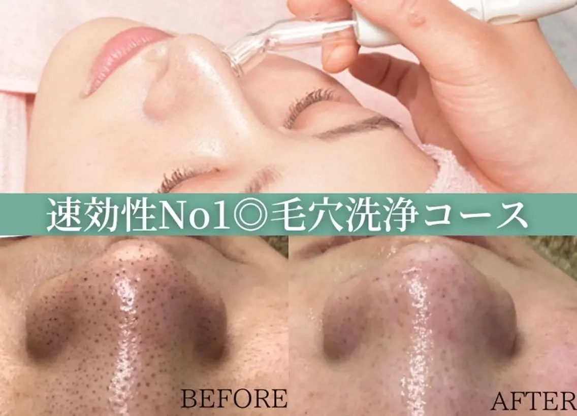毛穴洗浄コース👃🏻✨イチゴ鼻とはサヨナラ!黒ずみ毛穴/つまり毛穴/開き毛穴でお悩みの方に!の写真
