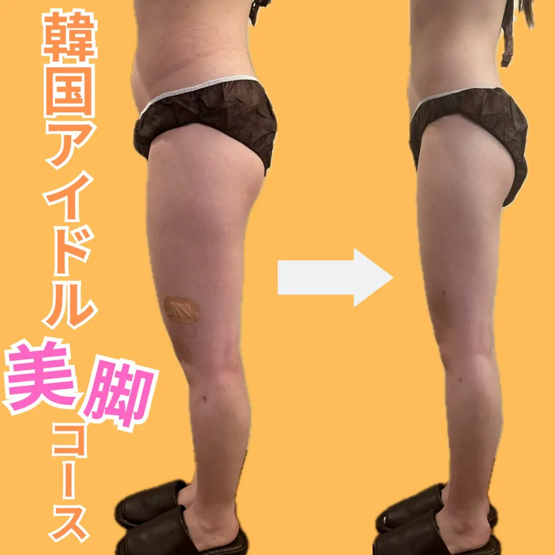 〚下半身太りにお悩みの方✨〛どれだけガチガチ頑固な脚も過去最高のスーパー美脚に🎵食べて痩せる‼️劇的大幅サイズダウン！の写真